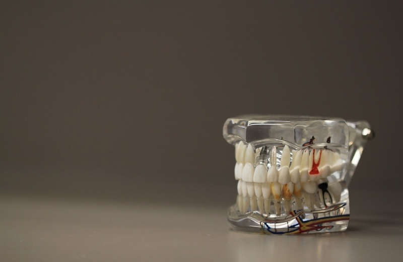 Parodontni džepovi - što su, te kako spriječiti njihov nastanak?