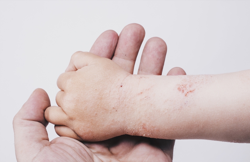 Atopijski dermatitis - sve što morate znati