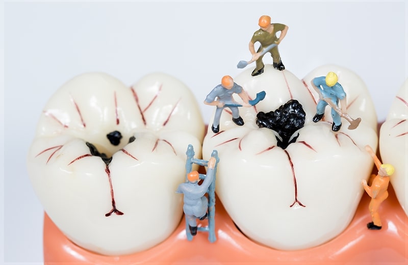 Karijes - najčešća bolest zuba u svijetu