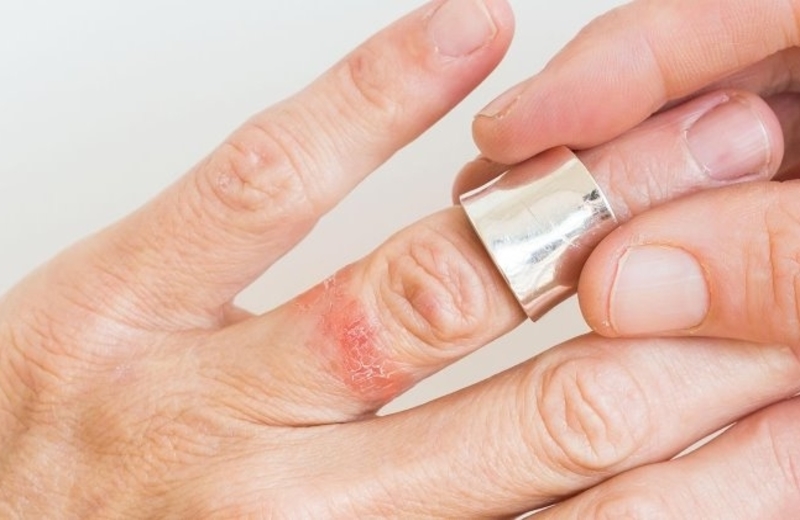 Kontaktni dermatitis - zbog čega je nastala reakcija na koži?