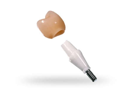Implantanti