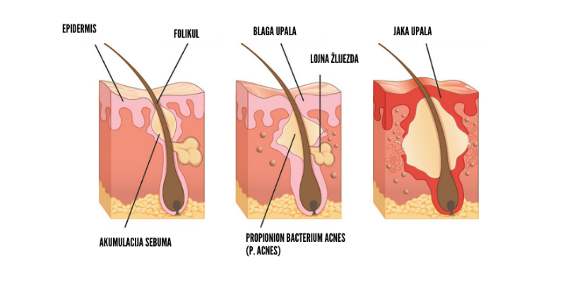 akne, acne vulgaris, lice