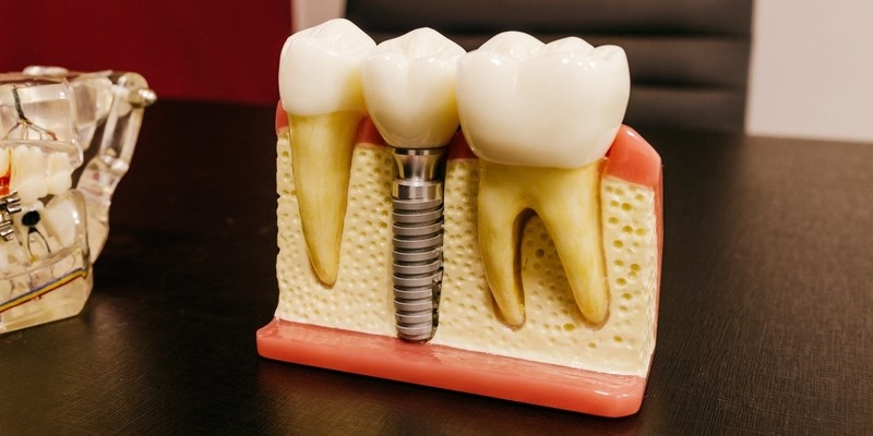 zubni implantati, stomatolog, implantat, dentalna medicina